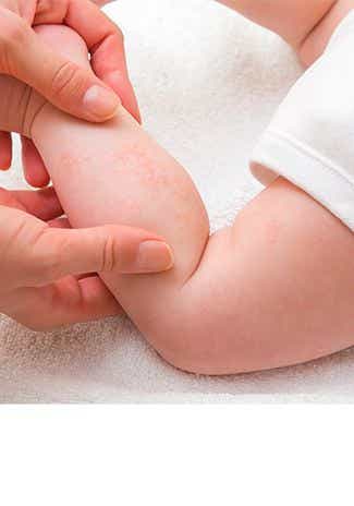 Quelles sont les causes de l'eczéma chez bébé ?