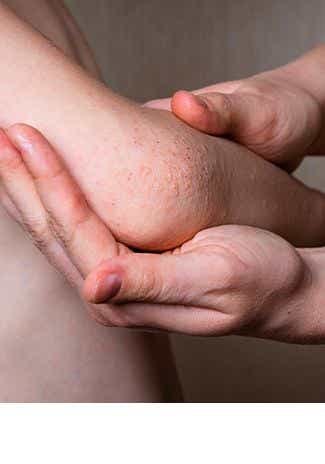 Dermatite atopique : qu'est-ce que la peau granuleuse chez l'enfant ? 