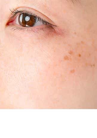 Comment enlever les taches brunes sur le visage