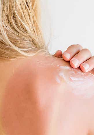 Comment apaiser des démangeaisons après un coup de soleil ?